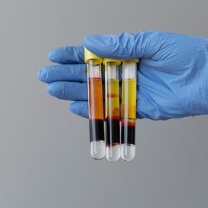 hand-with-glove-holding-vials-prp-treatment_23-2149404749